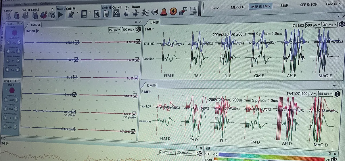 Monitor de sinais neurofisiológicos no centro cirúrgico
