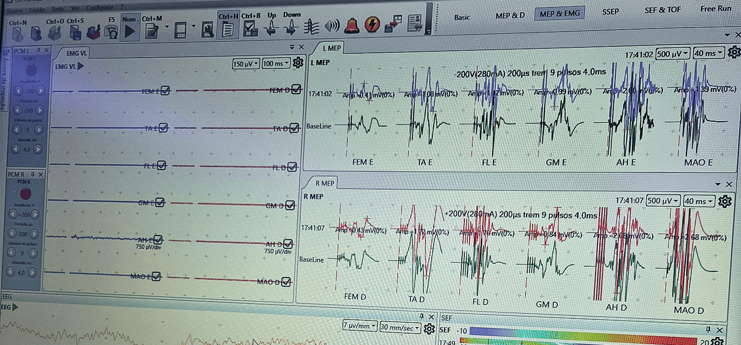 Monitor de sinais neurofisiológicos no centro cirúrgico.
